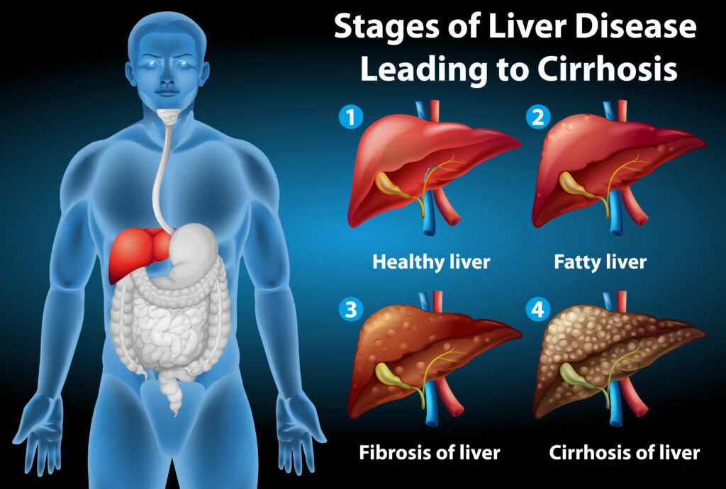 fatty liver diet