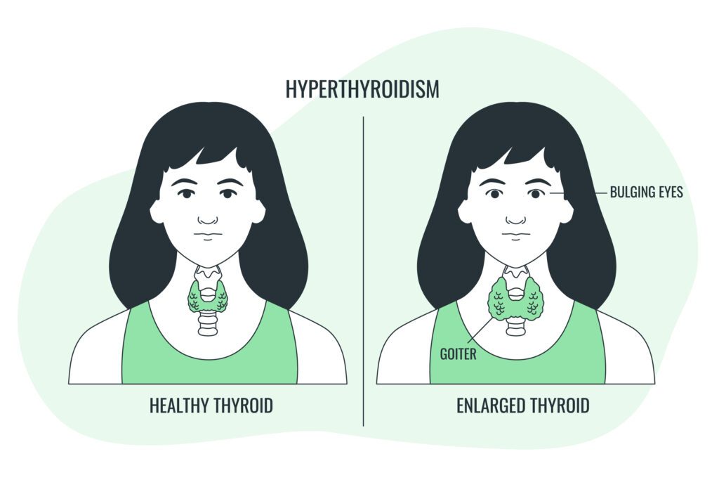 thyroid